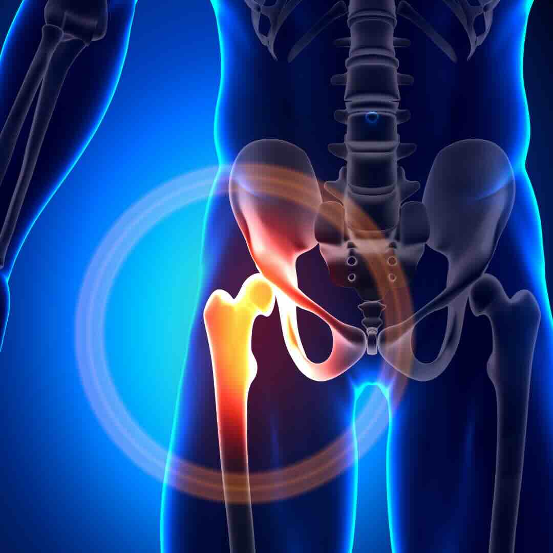 Hip Arthritis Pain Hip Arthritis pain