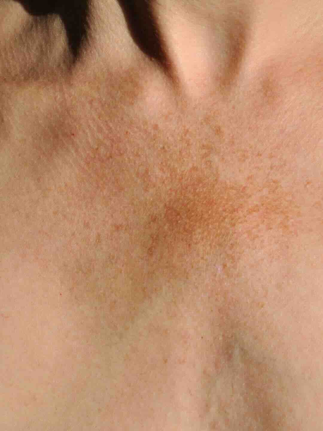 Psoriasis-Eczema