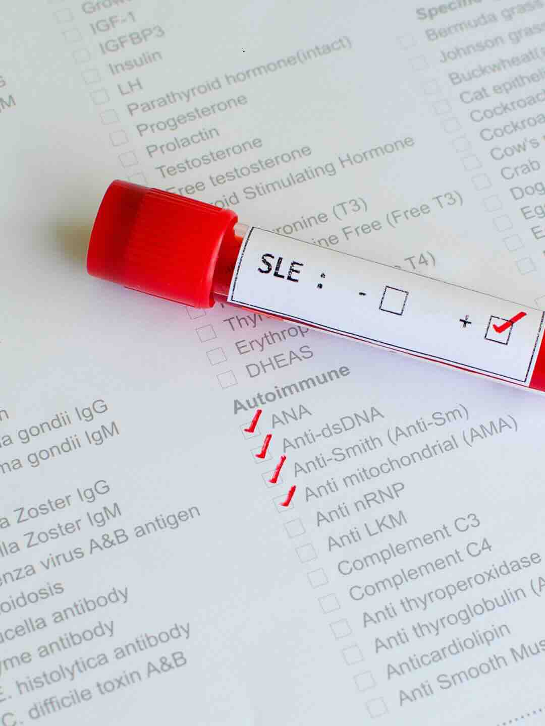 Lupus SLE<br />
